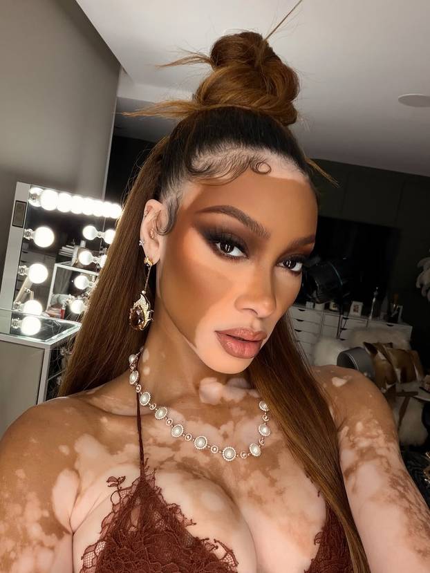 FOTO Rugali su joj se zbog bolesti, a danas je obožavaju zbog jedinstvenog izgleda