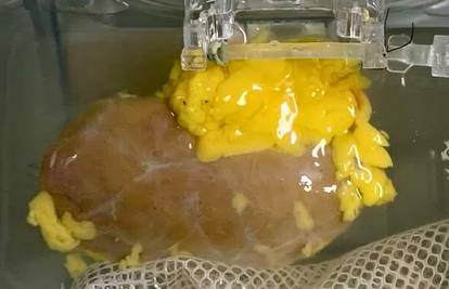 SENZACIONALNO Jedan bubreg za sve! Otkrili su kako 'brisati' krvne grupe, rezultati su čudo!