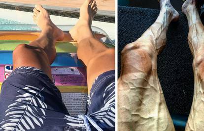 Grozno: Kako izgledaju noge prije i poslije Tour de Francea