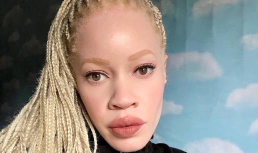 FOTO Afrikanka s albinizmom osvaja modnu industriju: 'Često privlačim znatiželjne poglede'