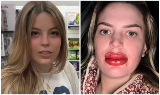 VIDEO Tetovirala usne pa joj ekstremno otekle: 'Horor, izgledam kao lik iz crti&cacute;a!'