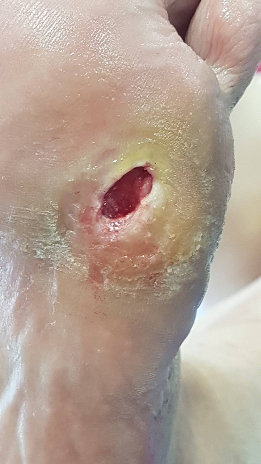 Od slabe cirkulacije do amputacije