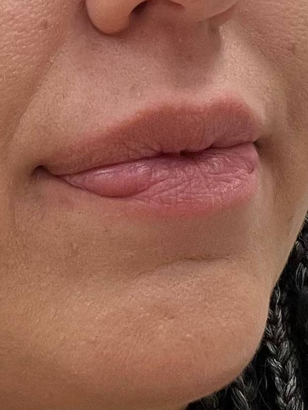 Na istog se estetskog kirurga žalila i Kristina Mandarina. Pogledajte kako je izgledala