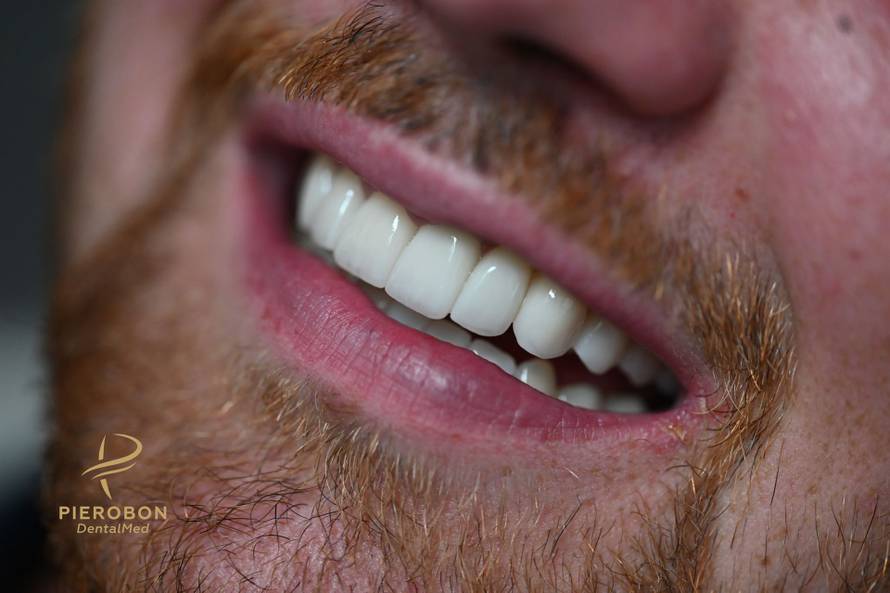 Sve o ulozi cirkonskih krunica u modernoj stomatologiji