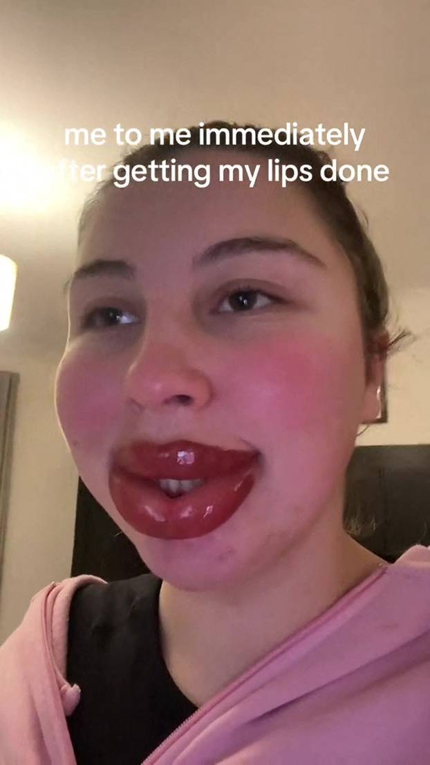 EXCLUSIVE: VIDEO: ‘Extreme allergic reaction to lipstick tattoo left me looking like Monsters Inc character’