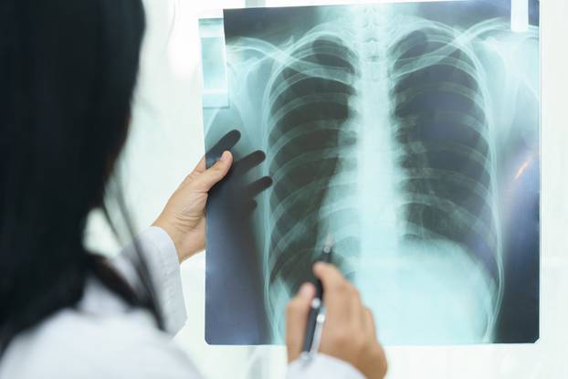 Female doctor examining about lungs with x-ray film - sick conce