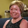 Ima rijetku bolest kože: 'Ljudi  misle da sam gorjela u požaru'