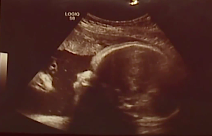 Slika ultrazvuka iznenadila je buduće roditelje: 'Što je to?!'