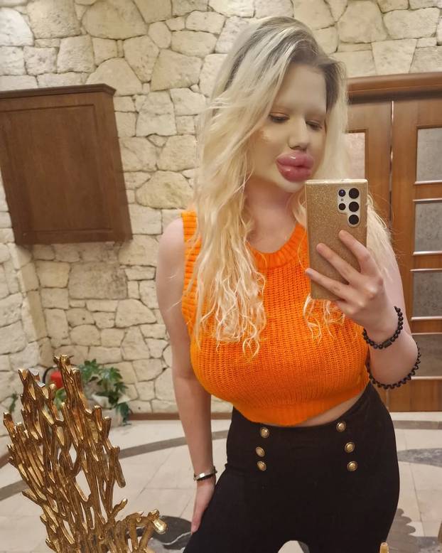 FOTO Andrea ima najveće usne na svijetu: Teško se smijem, ali ne mislim stati s operacijama...