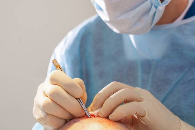 Baldness treatment. Hair transplant. Surgeons in the operating room carry out hair transplant surgery. Surgical technique that moves hair follicles from a part of the head.