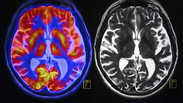 Otkriven novi oblik demencije - simptomi su slični Alzheimeru