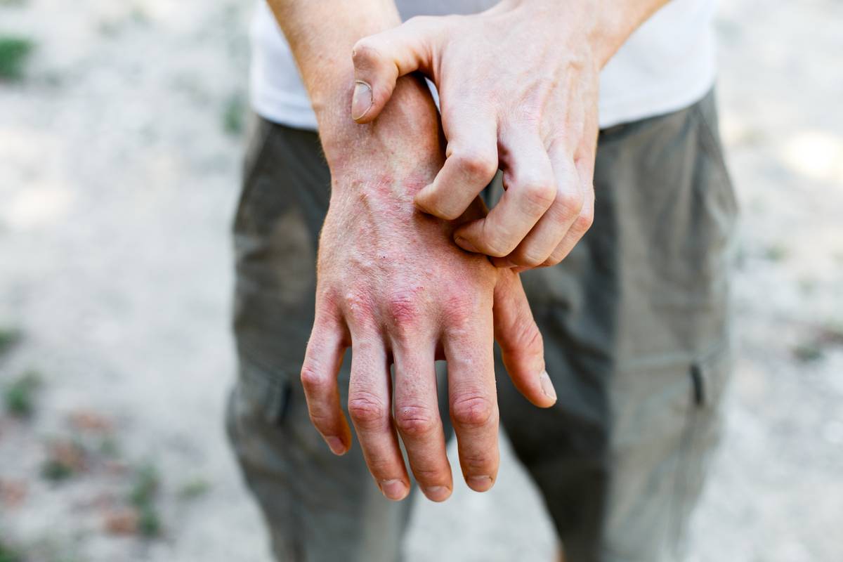 15 savjeta kako pomoći sebi i djeci s atopijskim dermatitisom