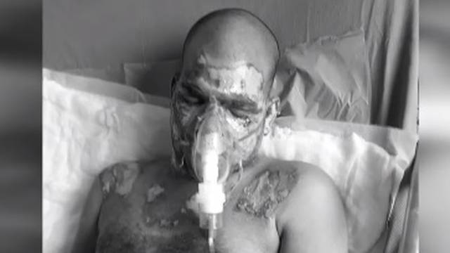 Bolesni plan: Ljubavniku spalila lice da bi uzeo mužev identitet