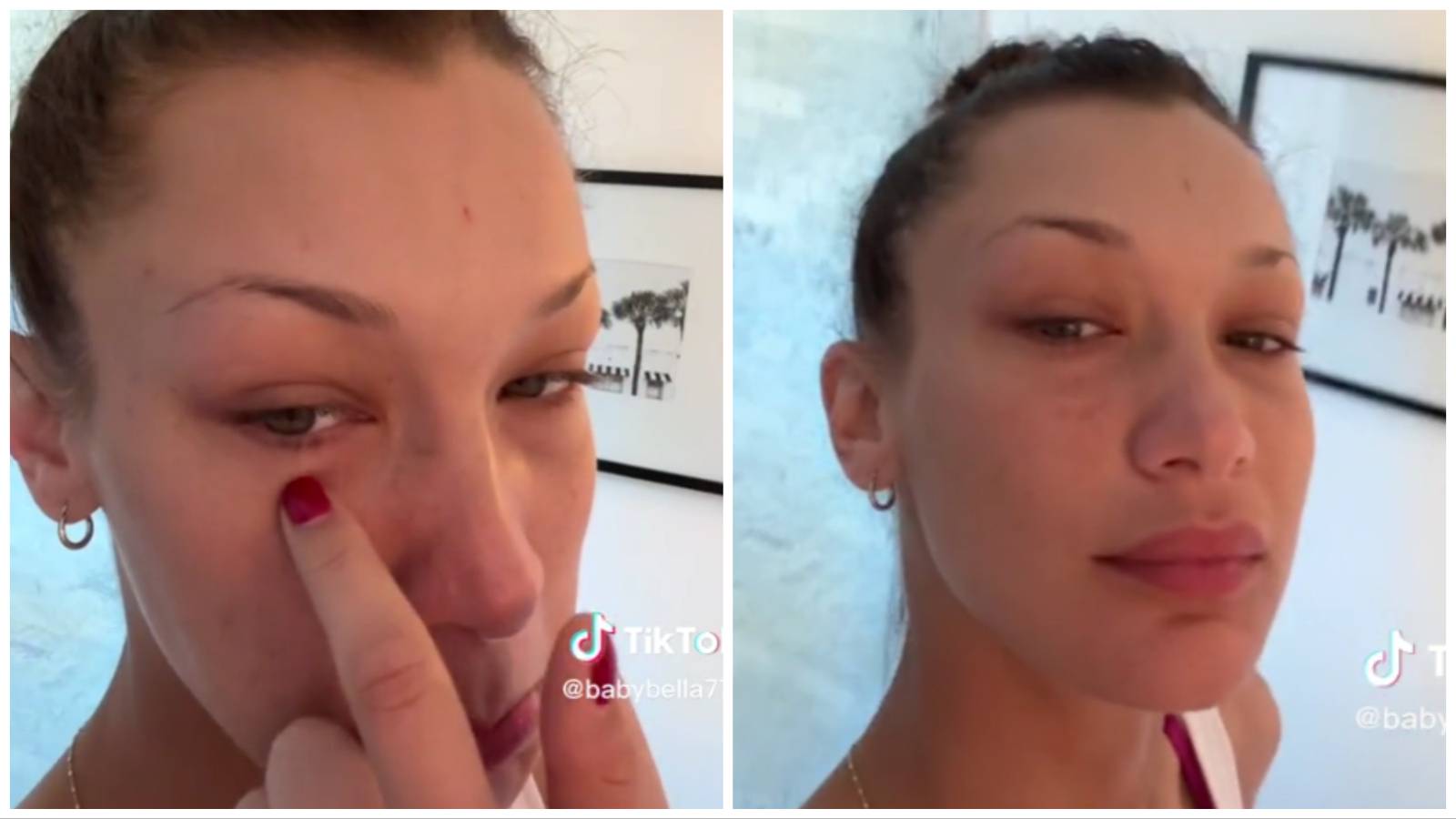 VIDEO Bella Hadid o izazovima nakon infekcije čeljusti: 'Molim vas, poslušajte svoje tijelo...'