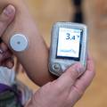 Važan iskorak za oboljele od dijabetesa tip 2: Stigli senzori za bezbolno mjerenje glukoze