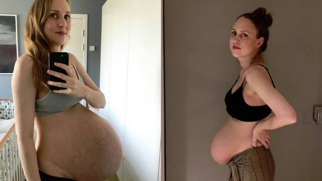Blogerica pokazala svoje tijelo 4 tjedna nakon poroda trojki