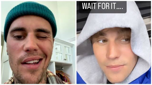 Justin Bieber snimio video kako pomiče lice zbog teške borbe sa sindromom: 'Ide mu sve bolje...'