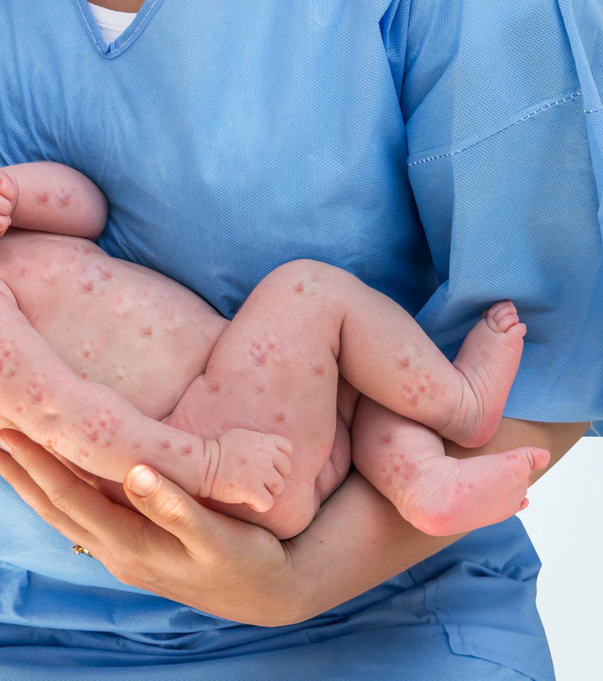 Panika zbog epidemije: 'Stanje je ozbiljno, treba cijepiti djecu'