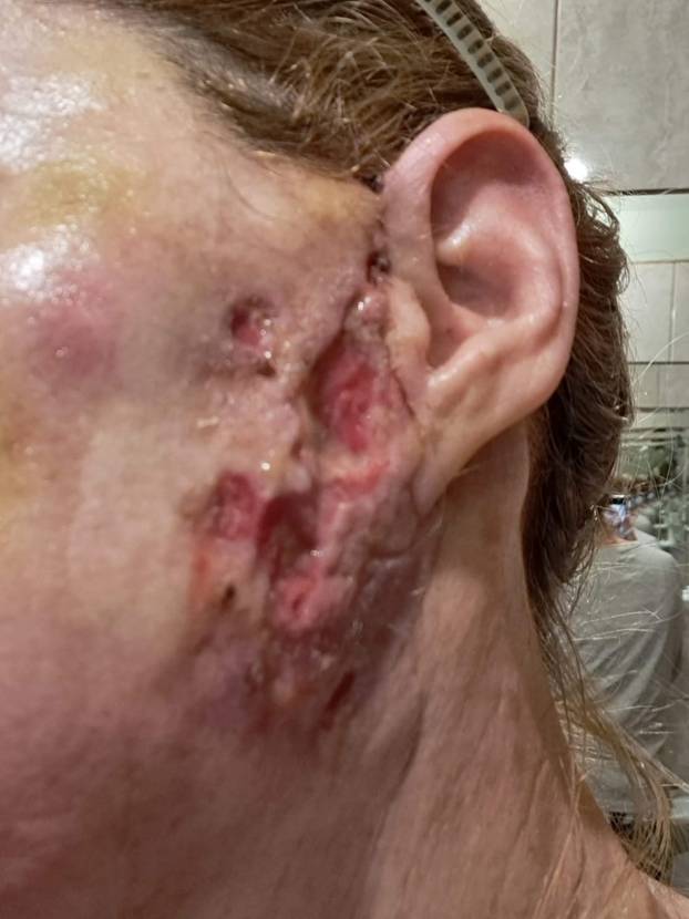 Na istog se estetskog kirurga žalila i Kristina Mandarina. Pogledajte kako je izgledala