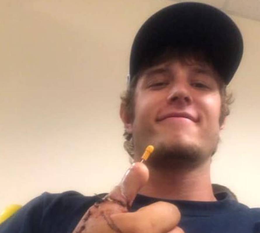 Nakon što si je odrezao palac na ruku su mu prišili prst noge