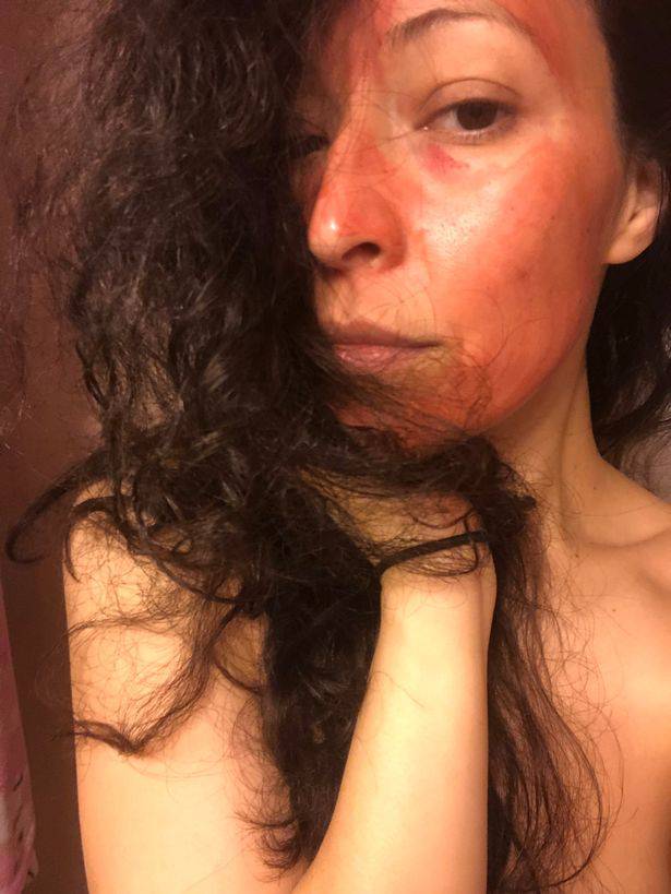 Bizaran beauty tretman: Na lice stavlja svoju krv da bude ljepša
