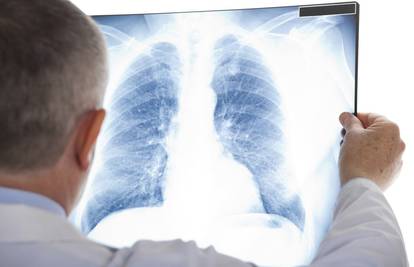 Opasna tuberkuloza: Jedan oboljeli može zaraziti 15 ljudi