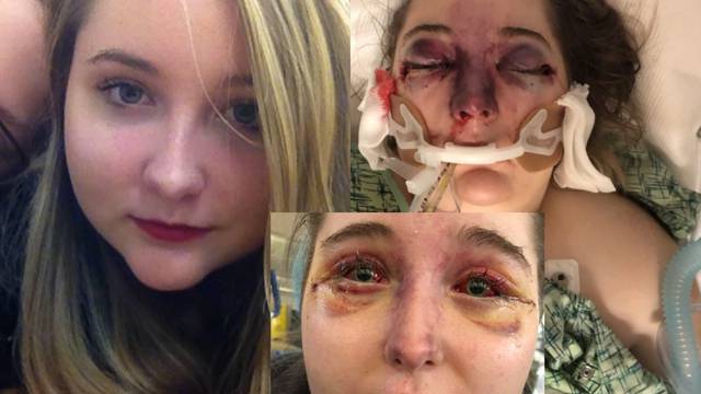 Liječnici zbunjeni: Djevojci (15) lice toliko oteklo da je oslijepila