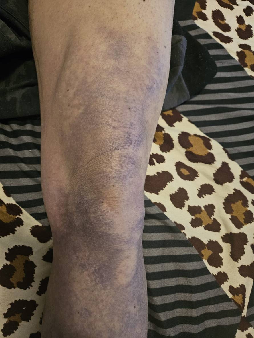 Super Silva za 24sata: Znam tko me napao, bilo je iznenada i s leđa. Jedna noga mi je uništena