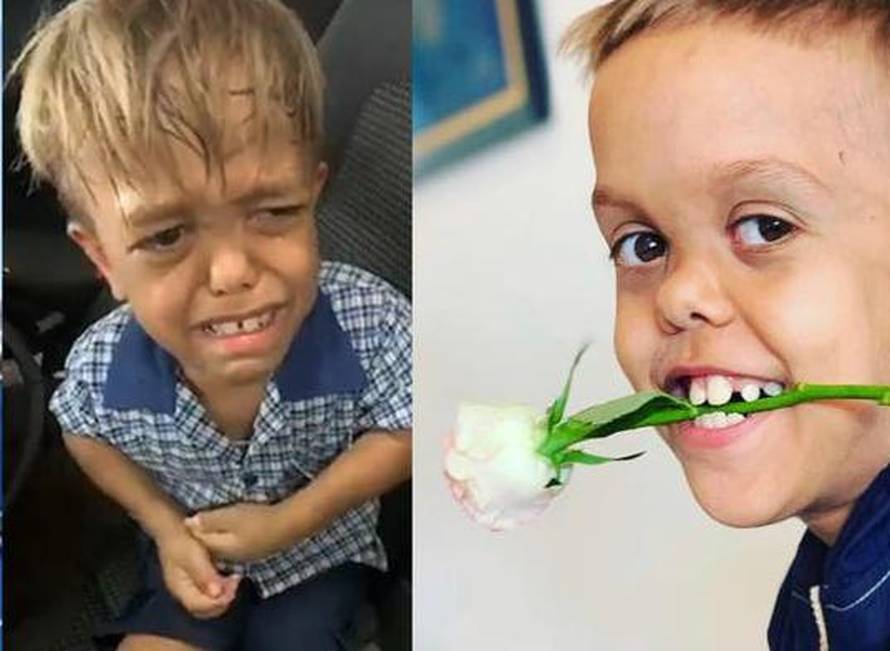 Maltretirani dječak Quaden Bayles