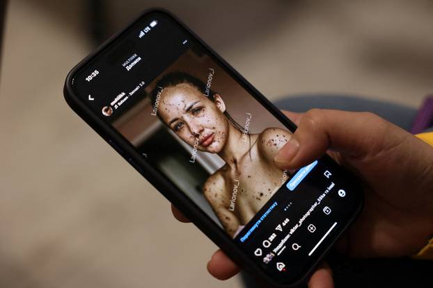 Former Ukrainian service member, who was wounded at a front line, comes to a clinic to treat scars, in Lviv