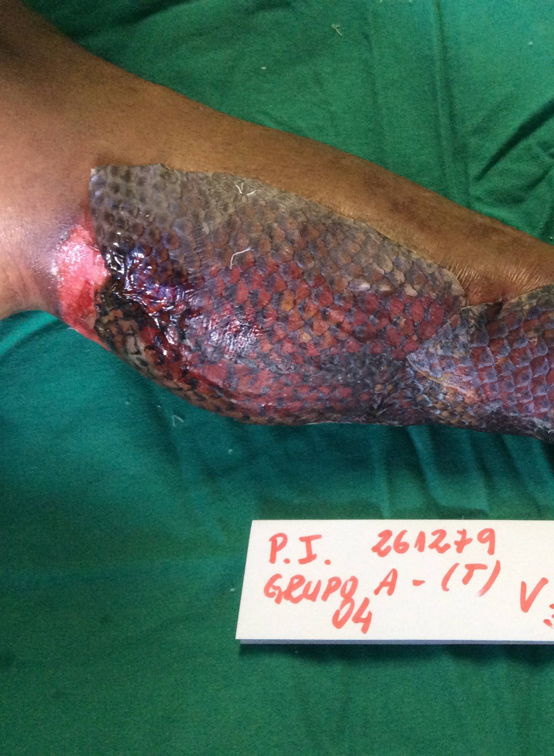 Burns survivor uses fish skin