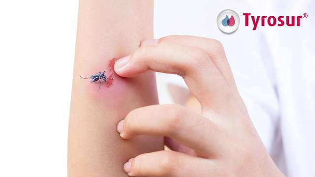 Što raditi s raščešanim ranama nakon uboda komaraca?