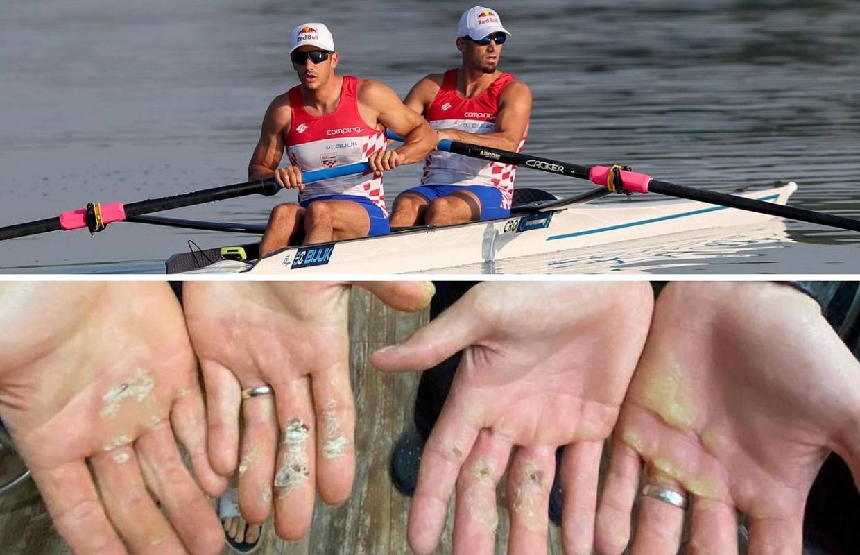 Ovako izgledaju dlanovi braće Sinković nakon 500 km veslanja