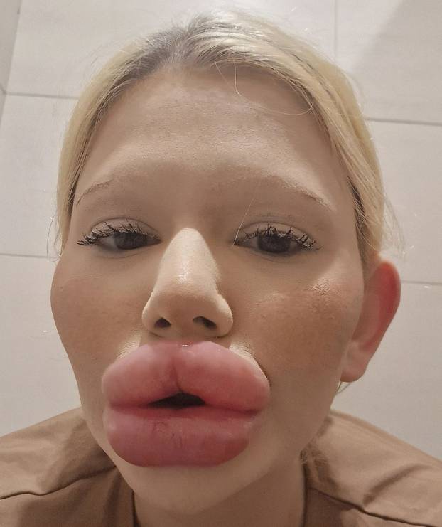 FOTO Žena s najvećim usnama na svijetu otkrila kako je nekoć izgledala: Šok! Bila si prekrasna
