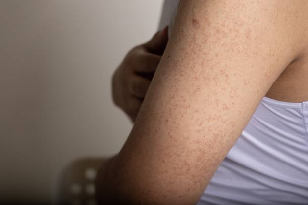Kvržica, madež ili neka druga promjena na koži? Ovo su znakovi da trebate liječniku