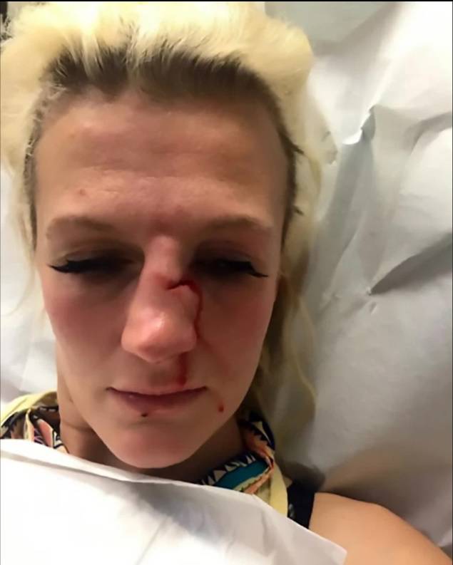 MMA borkinja prekinula je s dečkom, a on joj razbio nos!