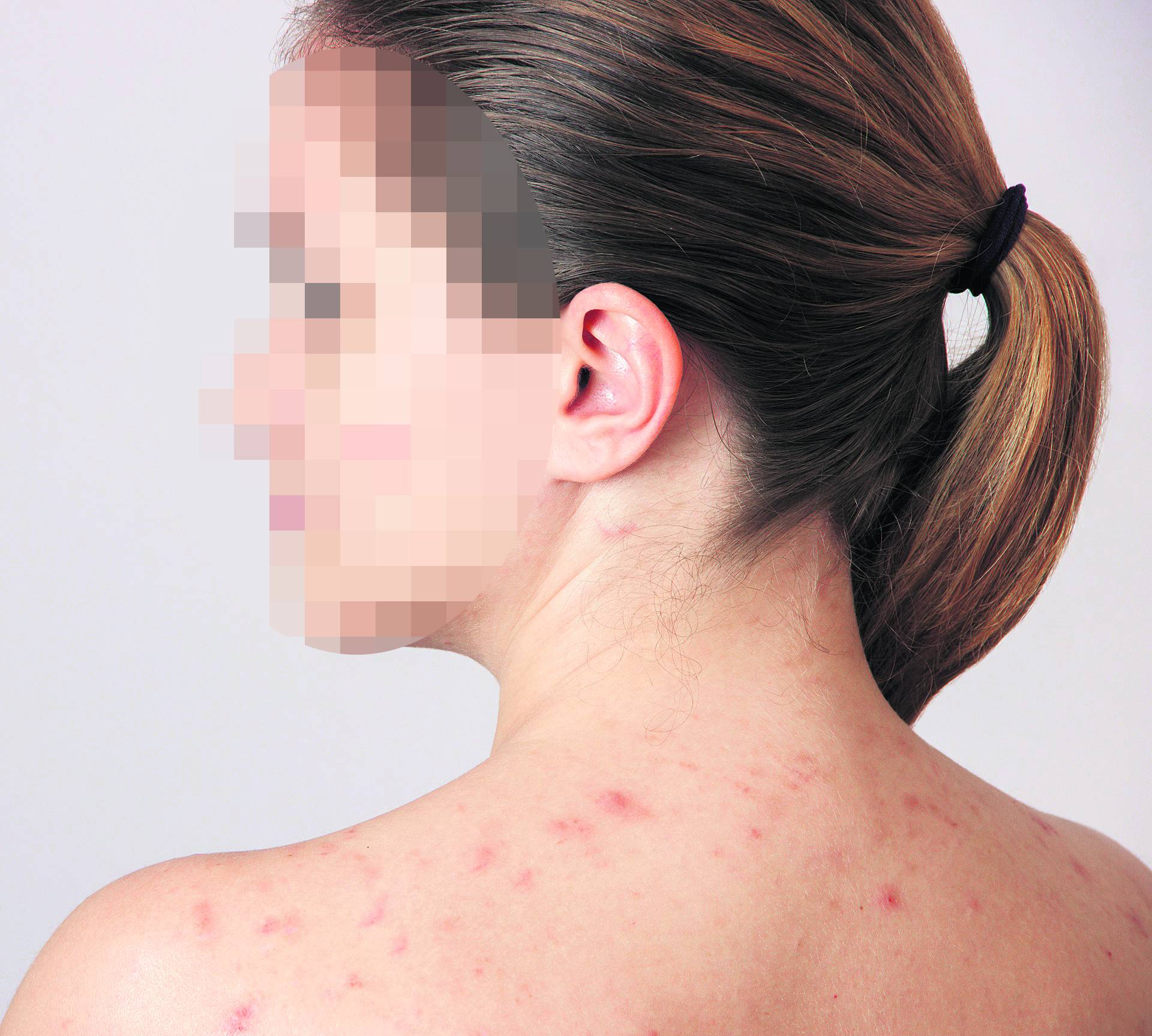 Beautiful young girl with acne on his face and the back on a whi