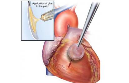 Napravili su novo "pametno ljepilo" za operacije na srcu
