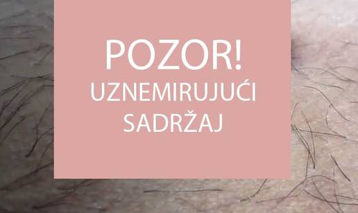 Koja higijena: Nećete vjerovati što su mu izvukli iz pupka