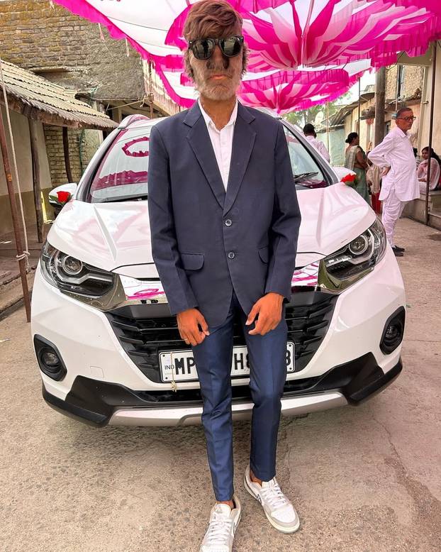 FOTO Ovaj mladić (18) pati od sindroma vukodlaka: U školi me sprdaju, ali volim svoje dlake...