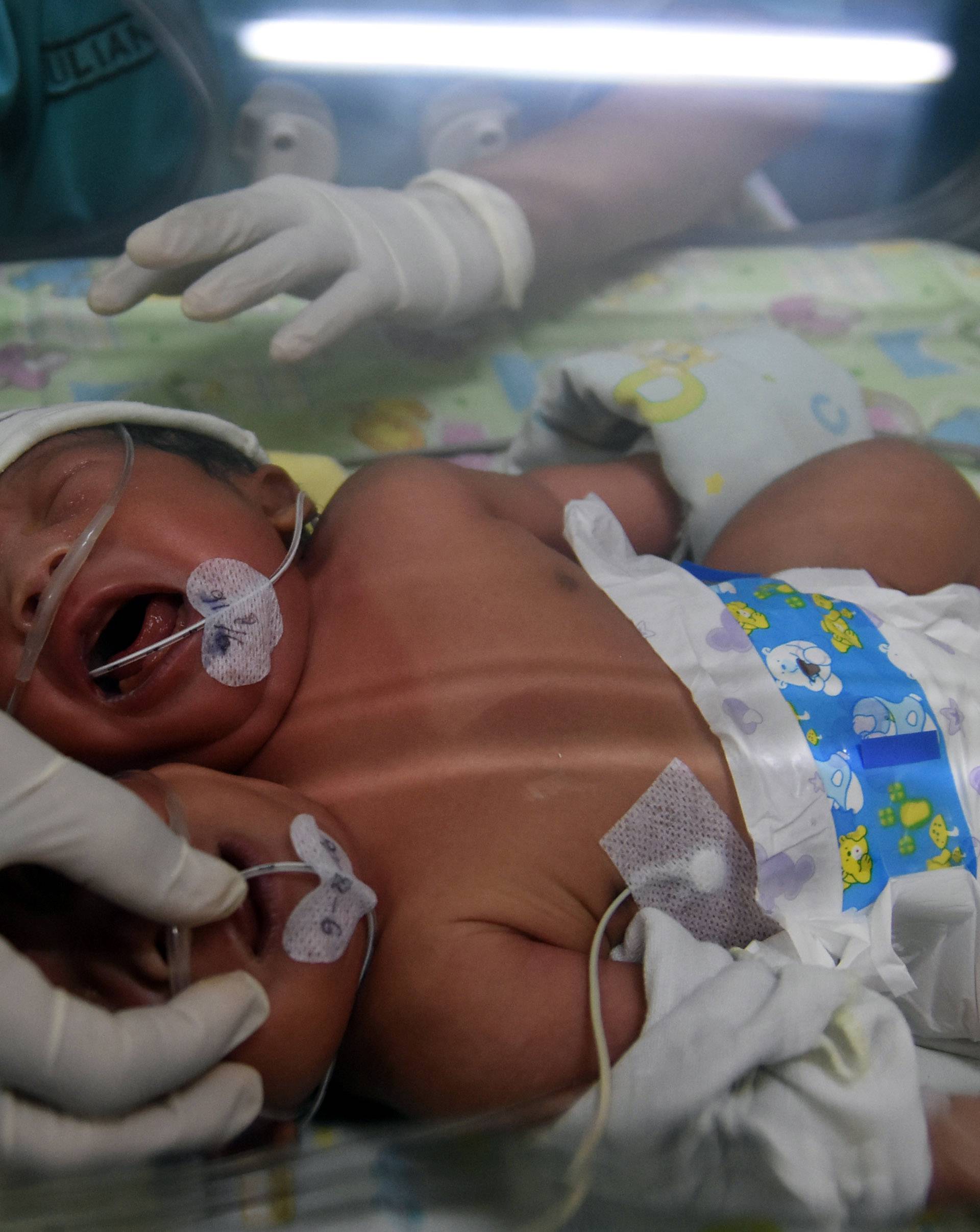 Two Headed Baby Born In Indonesia