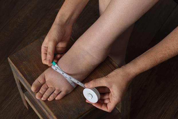 Woman,Measuring,Foot,Affected,By,Lymphedema,Condition,With,Tape,Measure