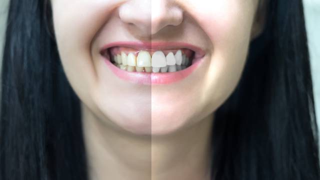 Žuti zubi su snažniji od bijelih zato ne forsirajte izbjeljivanje