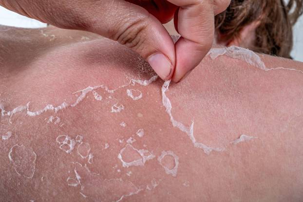 Dermatolozi savjetuju: Ovi prirodni lijekovi za opekline od sunca nude brzo olakšanje