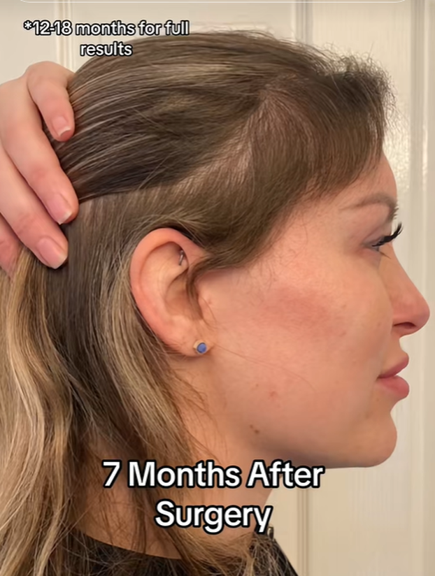 Dosadio joj izgled barbike pa se za 140.000 € 'popravila': Evo kako je izgledala prije zahvata