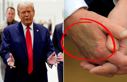 Doktor za 24sata o Trumpovoj modrici na ruci: Nema šanse da je to od rukovanja. Evo što je