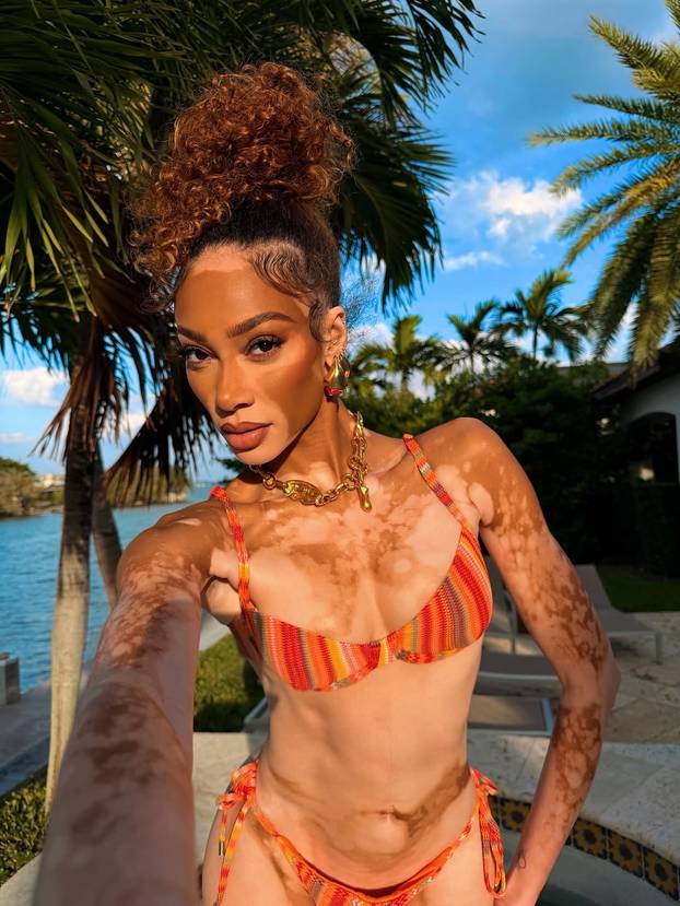 FOTO Rugali su joj se zbog bolesti, a danas je obožavaju zbog jedinstvenog izgleda