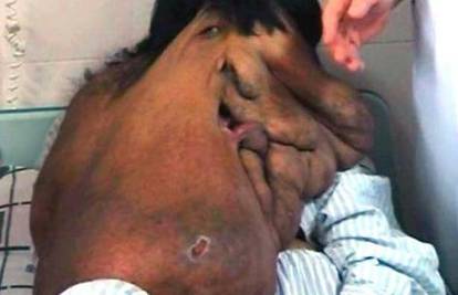 Kinezu će s lica ukloniti tumor od 15 kilograma