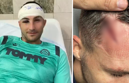 Hajdukov stoper pokazao kako mu izgleda glava nakon sudara: Zadobio užasnu posjekotinu
