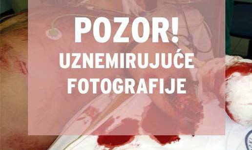 Mladiću su prišili odrezanu ruku i može micati prstima